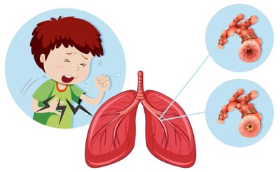 Biến chứng viêm phế quản phổi ở trẻ em là gì? Xem ngay cách cải thiện